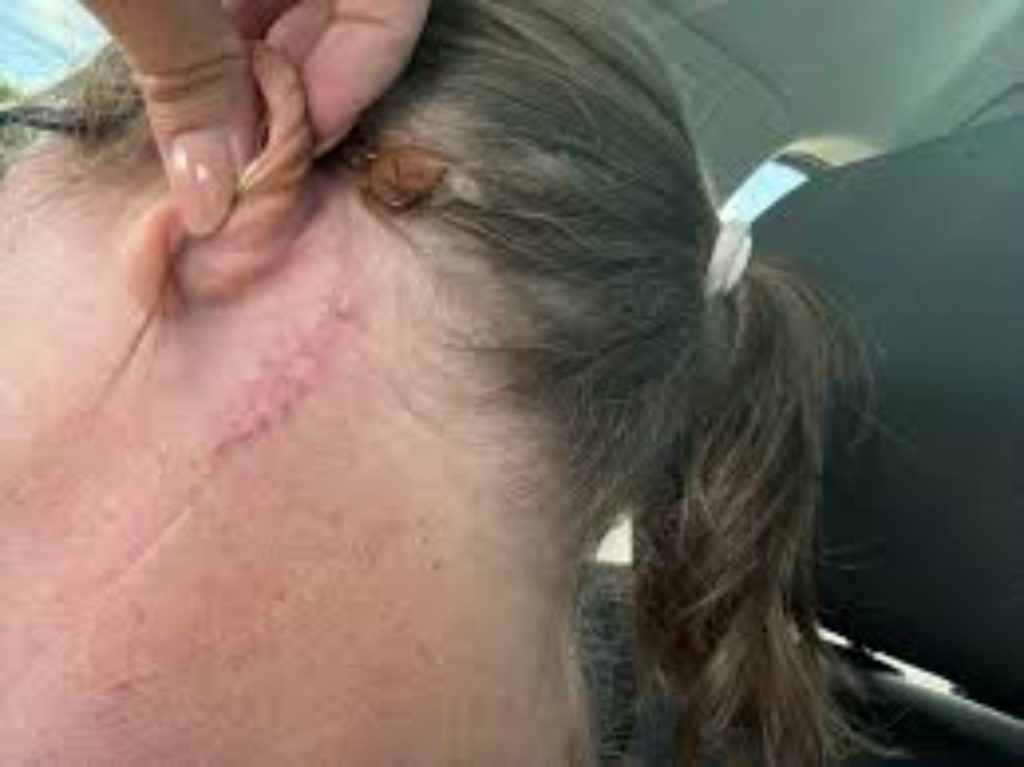 The Reality of Healing After Mohs Surgery