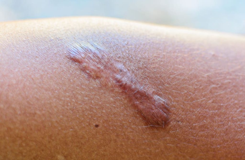 What Actually Determines How Much You Scar