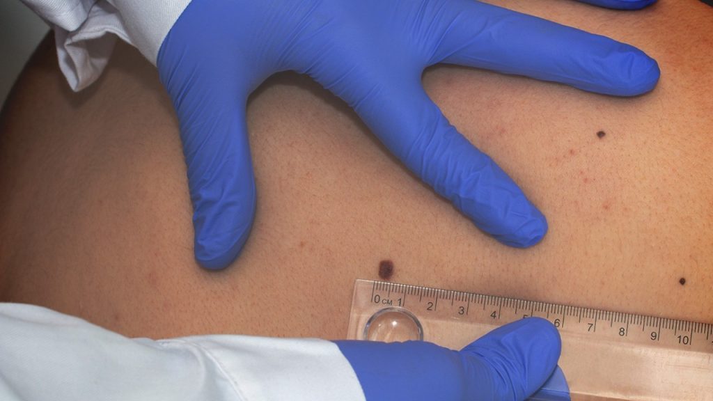 Why Mohs Surgery Is Recommended for Certain Skin Cancers