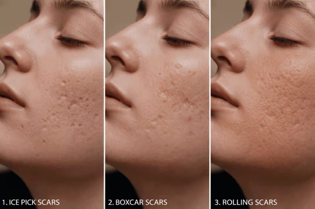 Rolling and Boxcar Scars: Where Lasers Do Their Best Work