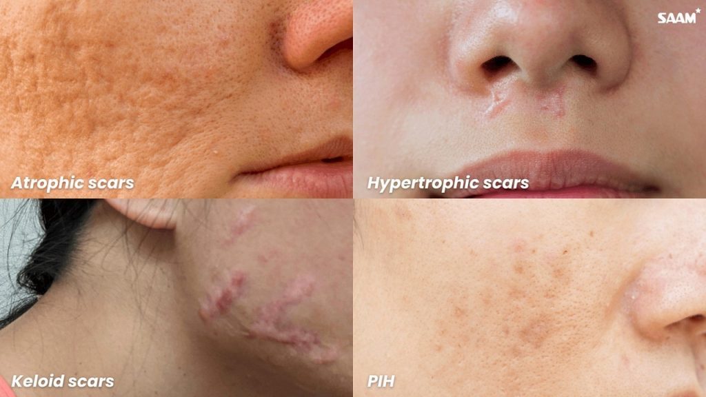 The Difference Between Atrophic and Hypertrophic Scars